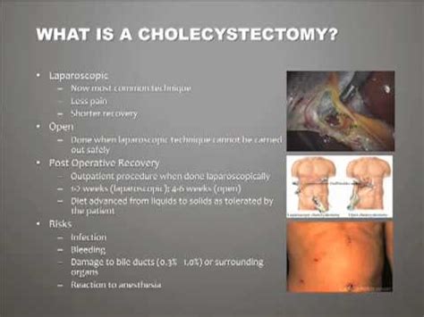 What is a Cholecystectomy? - YouTube