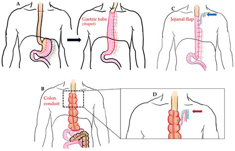 JCM | Free Full-Text | A Comparison of Different Types of Esophageal Reconstructions: A ...