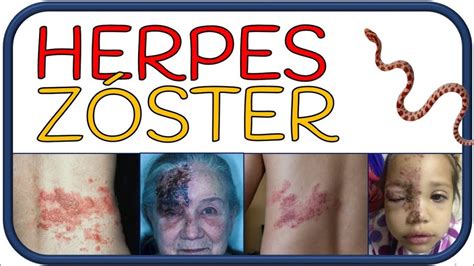 HERPES ZÓSTER - culebrilla, síntomas, herpes zóster oftálmico, Sx ...