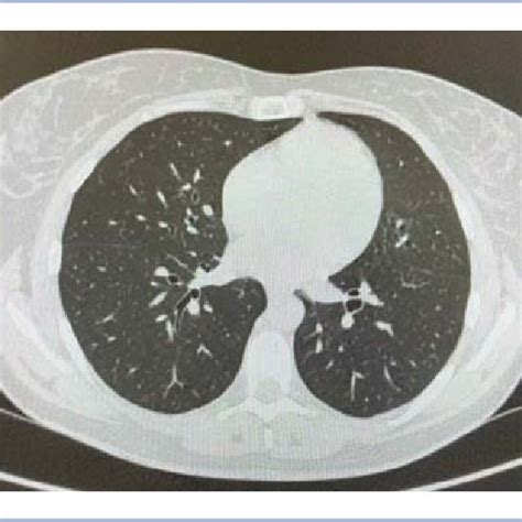 Savary dilation of a benign esophageal stricture. | Download Scientific Diagram