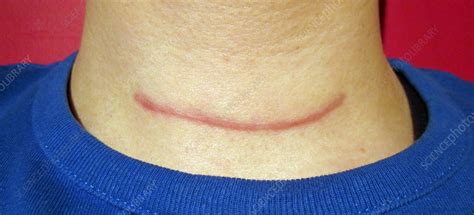 Thyroidectomy Scar - Stock Image - C043/6019 - Science Photo Library