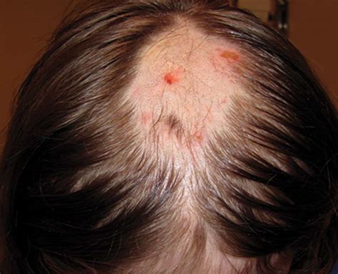 Trichotillomania (Hair Pulling): What It Is, Causes & Treatment