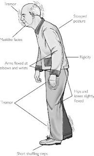 Definition and Description of the Waldenstrom's Disease | CanCer-666