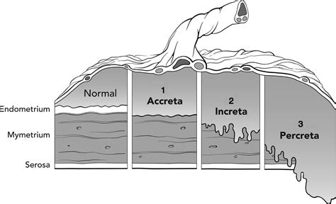 The Well-Rounded Mama: Placenta Accreta, Part Three: Risks to Mother and Baby