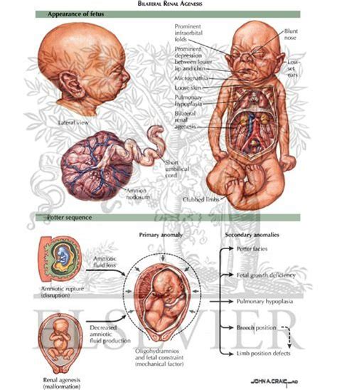 1000+ images about Potter's Syndrome...My son Carter had Bilateral ...