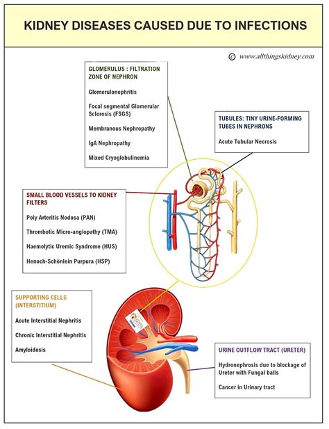 Infections that cause kidney damage - All Things Kidney ~ Official