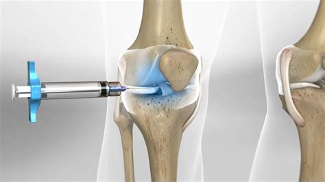 Knee Gel Injection: Clinical Treatments and Necessary Care ...