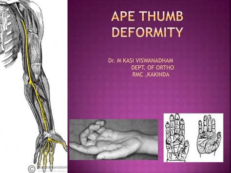 Ape thumb deformity to publish | PPT