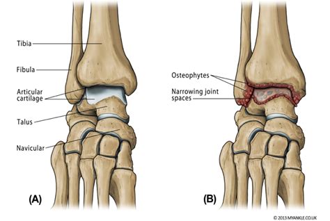 Ankle Arthritis — Ankle Arthritis | Ankle Replacement | Arthrodesis | Ankle Fusion