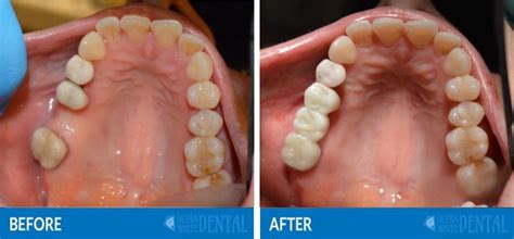 Dental Bridge Katy TX | Fixed Partial Denture | Replace missing Tooth