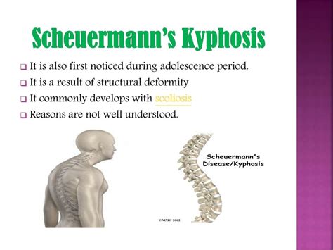 Scheuermann S Kyphosis