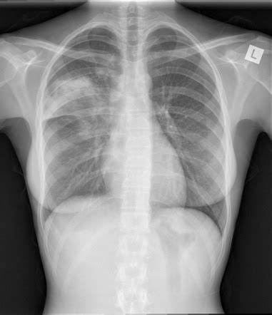 Chest X Ray Consolidation Vs Infiltrate