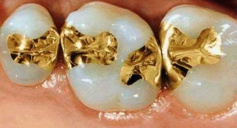 Gold Inlays and Onlays | DMS Dentistry