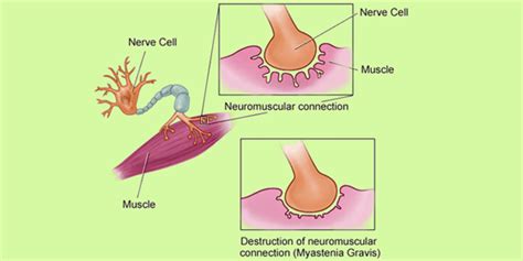 Myasthenia Gravis - Causes, Symptoms, Diagnosis and its Treatment