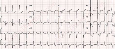 Left main coronary artery | LearntheHeart.com