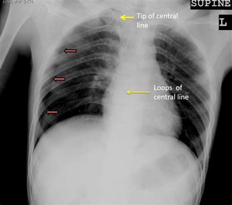 Iatrogenic pneumothorax – Radiology Cases