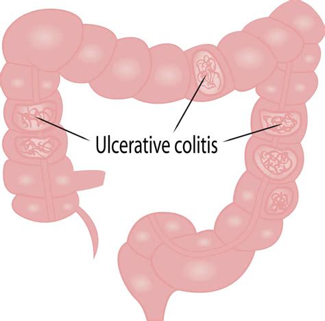 Ulcerative Colitis: Causes & Symptoms - Colonoscopy.com