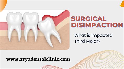 Surgical Disimpaction:- What is Impacted Third Molar? – Arya Dental Clinic