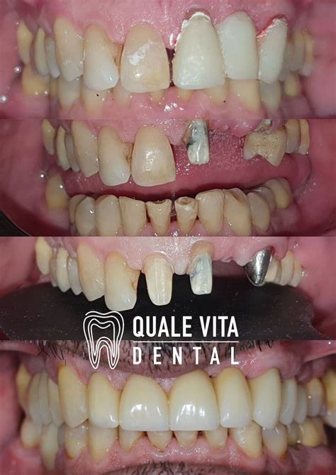 Bridge (Fixed Partial Denture) - Quale Vita