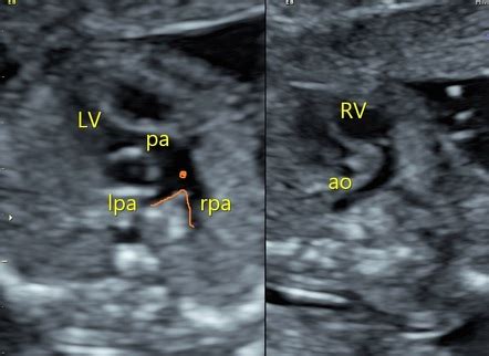 Transposition of the great arteries (TGA) - fetal echocardiogram | Image | Radiopaedia.org