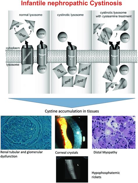 Clinical characteristics of individuals with cystinosis. (Top)... | Download Scientific Diagram