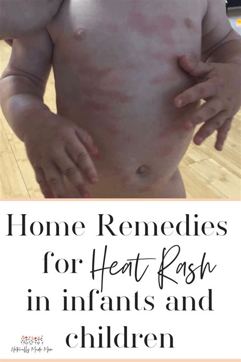 5 Effective Home Remedies for Baby Heat Rash | Heat rash, Baby heat rash, Heat rash remedy