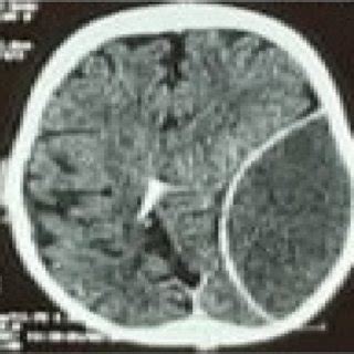 The CT scan of brain showing left extradural hematoma with mass effect ...