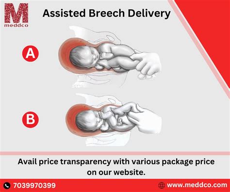 Why Is Assisted Breech Delivery Conducted? - Part 2