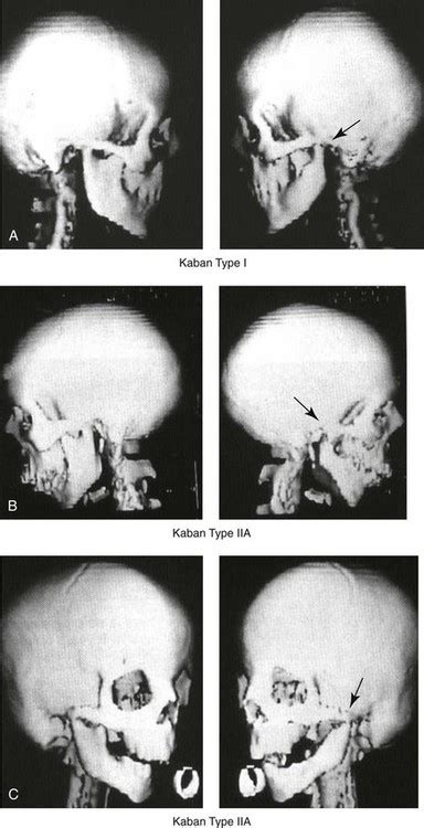 Hemifacial Microsomia: Evaluation and Treatment | Plastic Surgery Key