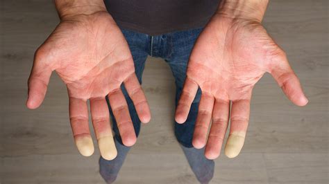 5 Signs of Raynaud's Disease and How to Manage It