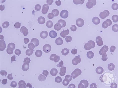 Leishman Stain 100X ; Howell Jolly bodies , Basophilic stippling , Bite ...