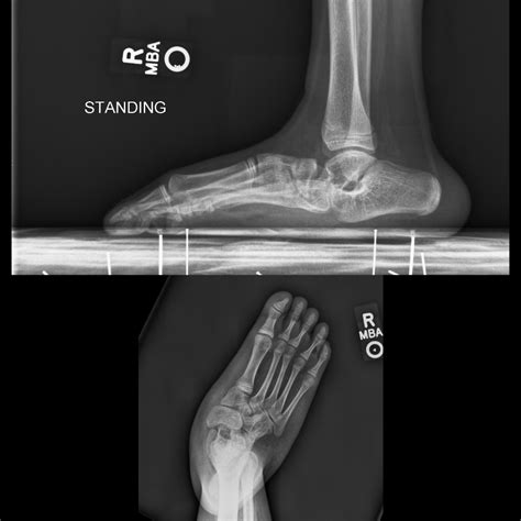 Pediatric Foot Alignment Deformities Article