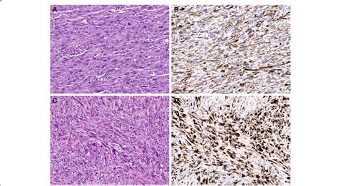 Representative pathology sections of sarcomatoid carcinoma ...