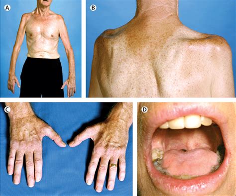 Amyotrophic lateral sclerosis - The Lancet