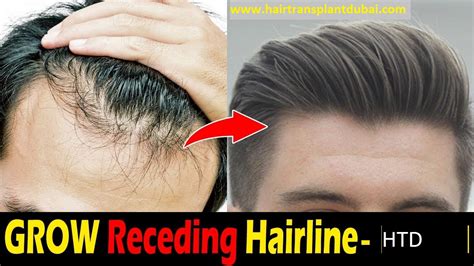 How Can I Grow My Hairline Home Remedies Tips And Tricks - Best Simple Hairstyles for Every Occasion