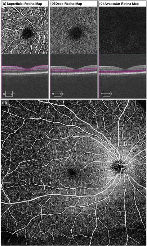 Optical coherence tomography angiography (OCTA) images of healthy human ...