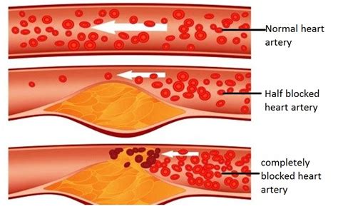 Ischemic Heart Disease: Definition, types, symptoms, causes, risk factors - Health, Fitness ...