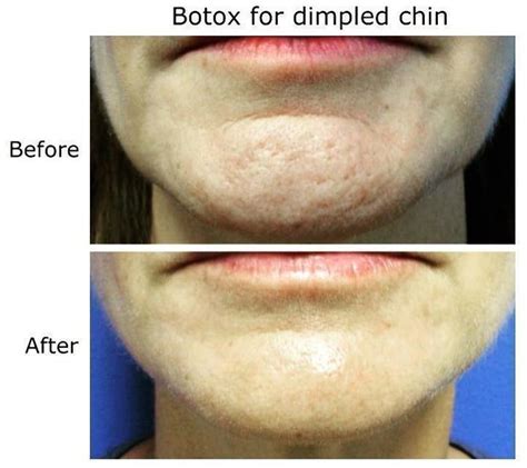 Botox For Dimpled Chin » Facial Injections: Info, Prices, Photos, Reviews, Q&A