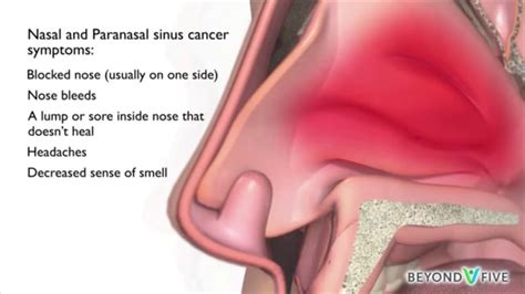 Nasal Cavity Sinus Cancer Pictures / Nose And Sinus Cancer Squamous ...