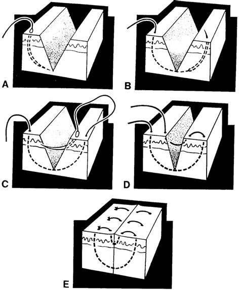 Horizontal Mattress Suture, The Mattress Sutures Vertical Horizontal And Corner Stitch American ...