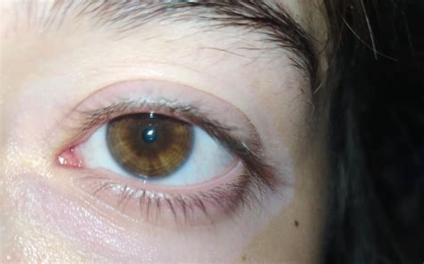 Brown eyes or central heterocromia? : heterochromia