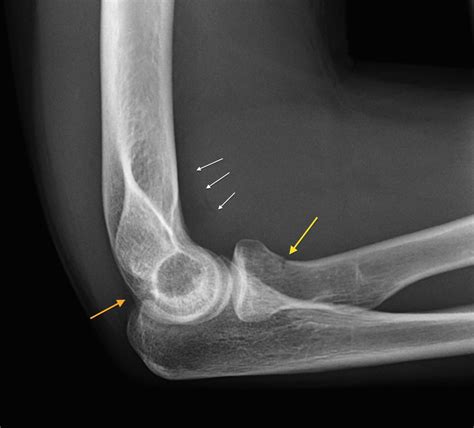 Radial neck fracture - Radiology at St. Vincent's University Hospital