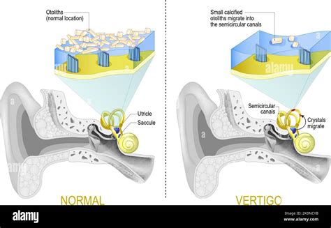 Benign paroxysmal positional vertigo. BPPV. labyrinth of the inner ear with Semicircular canals ...