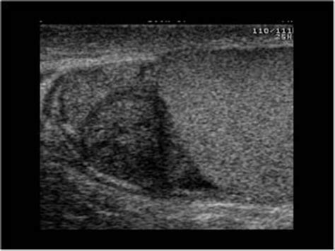 Urinary Tract and male reproductive system | 2.3 Scrotum : Case 2.3.6 Inflammation | Ultrasound ...