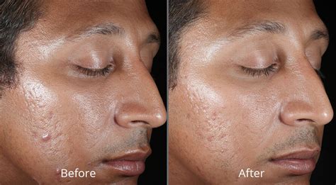 Chemical Peels | Chesapeake Vein Center & Medspa