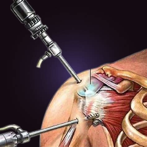 What Is Arthroscopy? – Welcome to SYS Medtech International Pvt. Ltd.