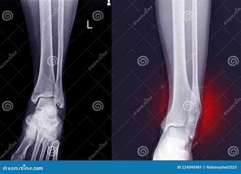 Distal Tibia Fracture And Distal Fibular Fusion Royalty-Free Stock Photography | CartoonDealer ...