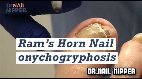 Ram's Horn Nail (onychogryphosis) trimming in podiatry office - YouTube