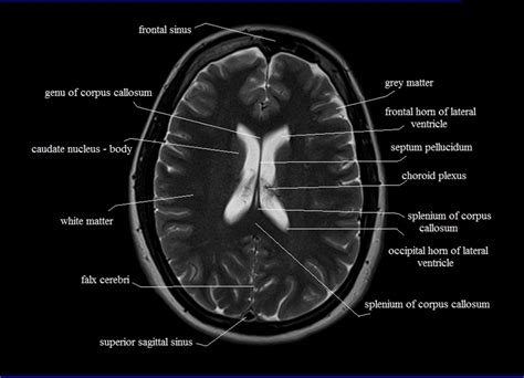 MRI anatomy | Free MRI Axial Brain Anatomy