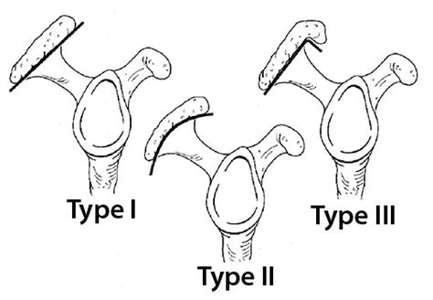 Understanding Acromioplasty - Academy of Clinical Massage